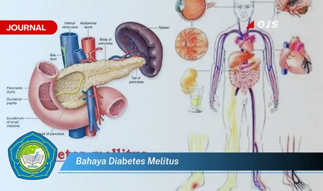 bahaya diabetes melitus