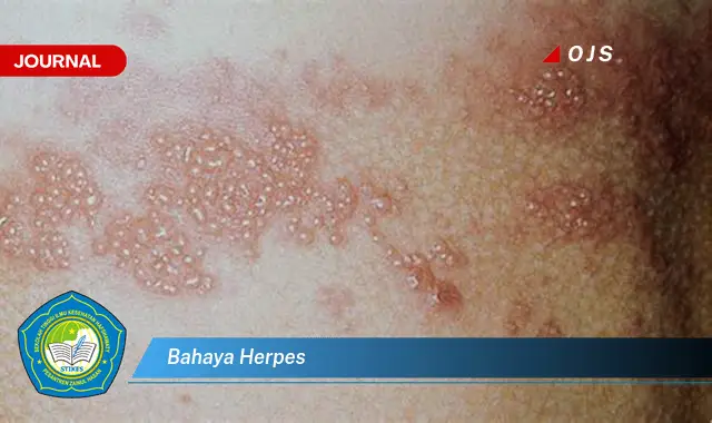 bahaya herpes