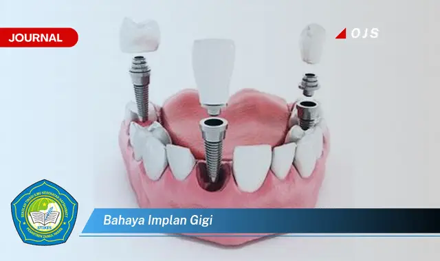 bahaya implan gigi bahaya implan gigi