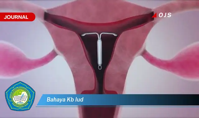bahaya kb iud bahaya kb iud