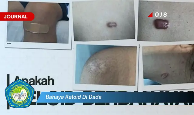 bahaya keloid di dada