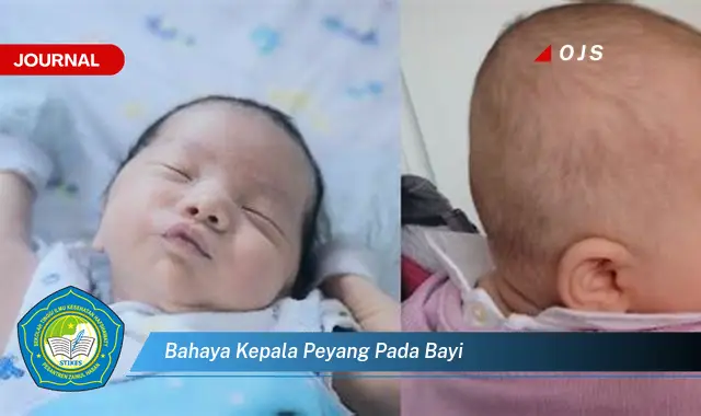 bahaya kepala peyang pada bayi