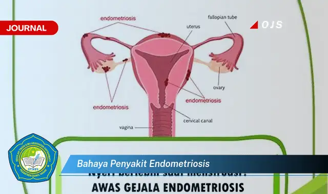 bahaya penyakit endometriosis