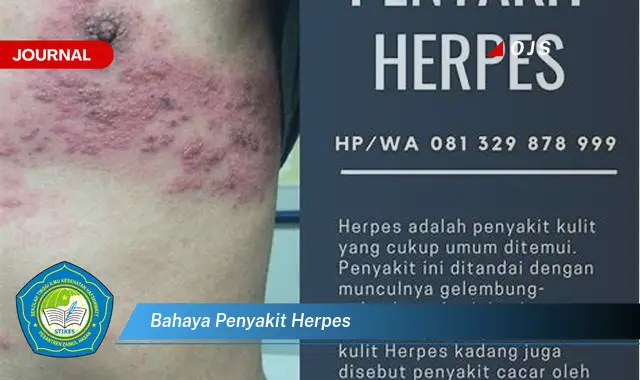 bahaya penyakit herpes