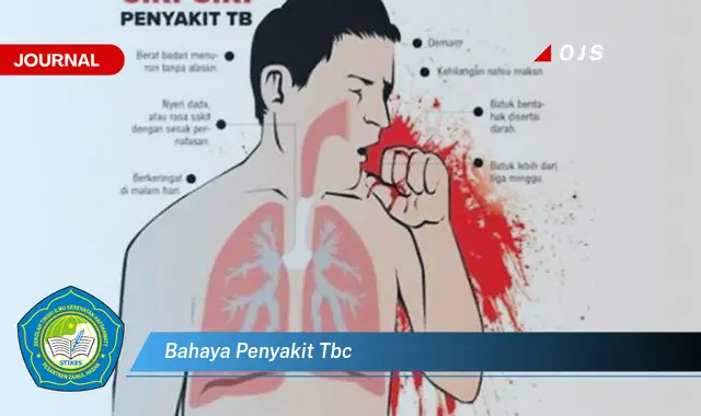 bahaya penyakit tbc