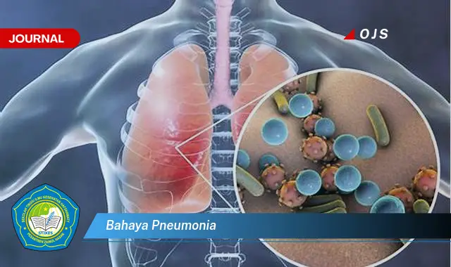 bahaya pneumonia