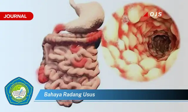 bahaya radang usus