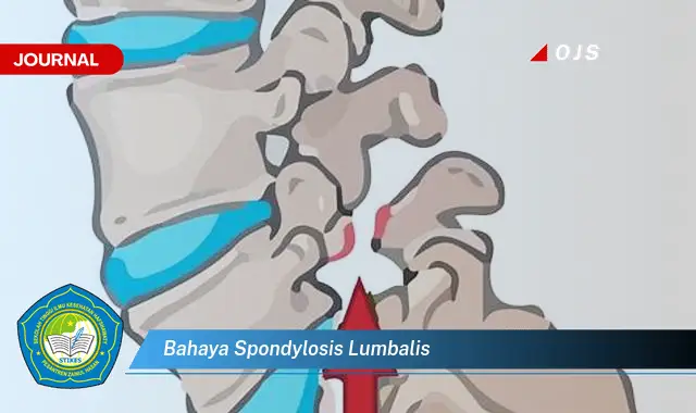 bahaya spondylosis lumbalis