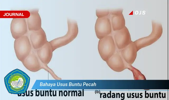 bahaya usus buntu pecah