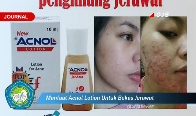 manfaat acnol lotion untuk bekas jerawat