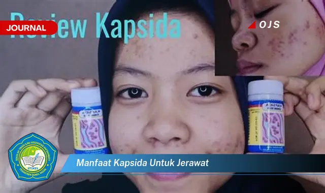 manfaat kapsida untuk jerawat